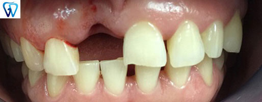 Root Canal Dentist 06611 Trumbull CT