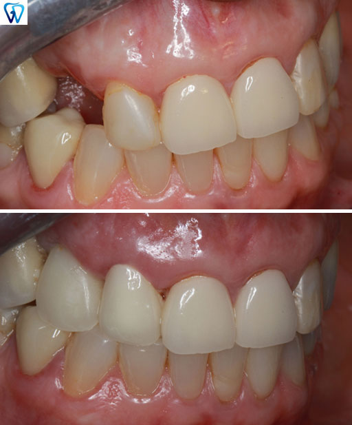 GD Dentistry | Ceramic Crowns, Invisalign reg  and Sinus Lift