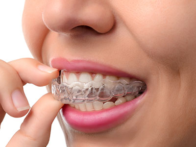 GD Dentistry | Sinus Lift, CEREC reg  and Extractions