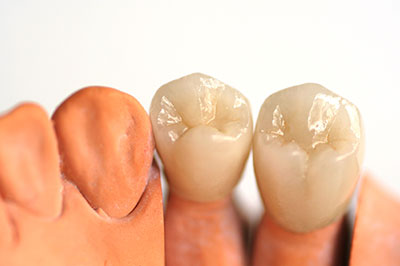 GD Dentistry | Dental Bridges, Dental Fillings and Sinus Lift