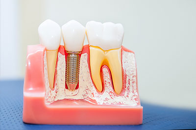 GD Dentistry | Sedation Dentistry, Extractions and Dentures