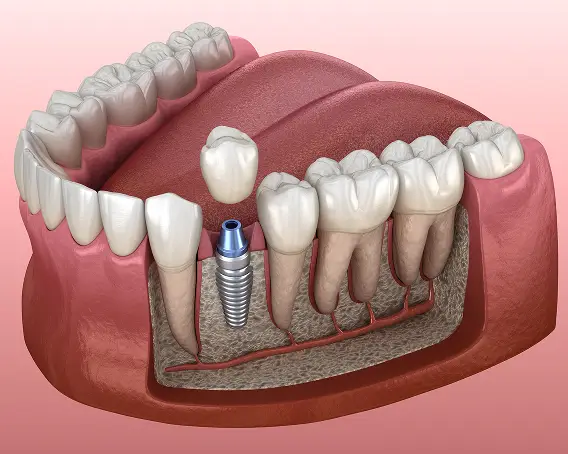 Illustration of a single dental implant and crown